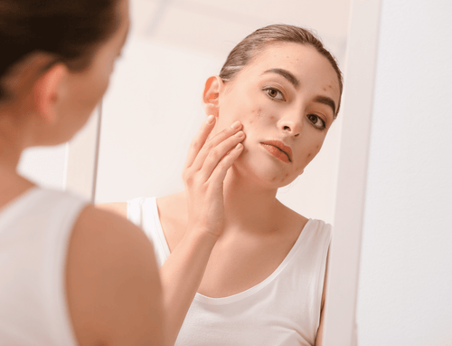 Acné Digestive : Lien entre alimentation et belle peau